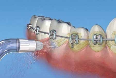 Behandlung von Zahnspangen mit einem Reizstoff
